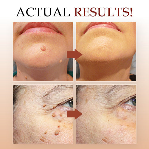 đ„Promotion 65% OFFđ„WipeOff recommends Tags & Moles Remover