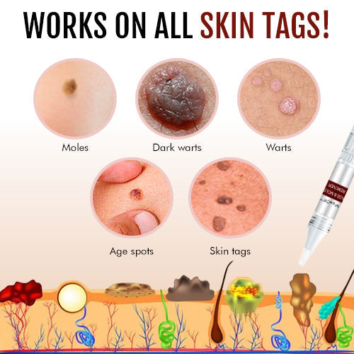 đ„Promotion 65% OFFđ„WipeOff recommends Tags & Moles Remover