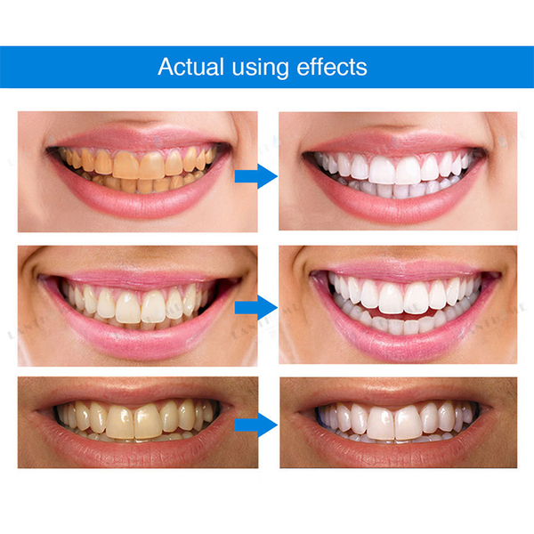 🔥Last Day 49% OFF Teeth Whitening Essence