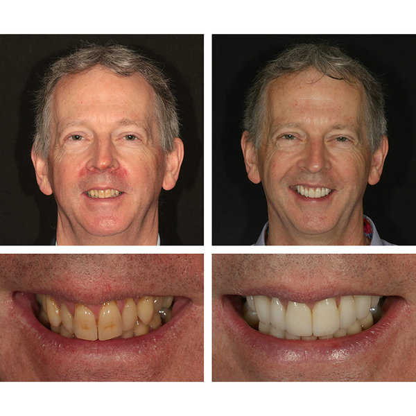 🔥Last Day 49% OFF Teeth Whitening Essence