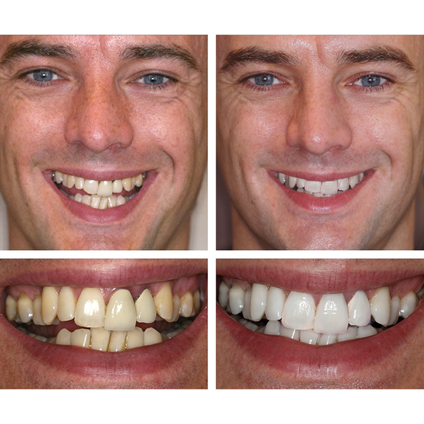 🔥Last Day 49% OFF Teeth Whitening Essence